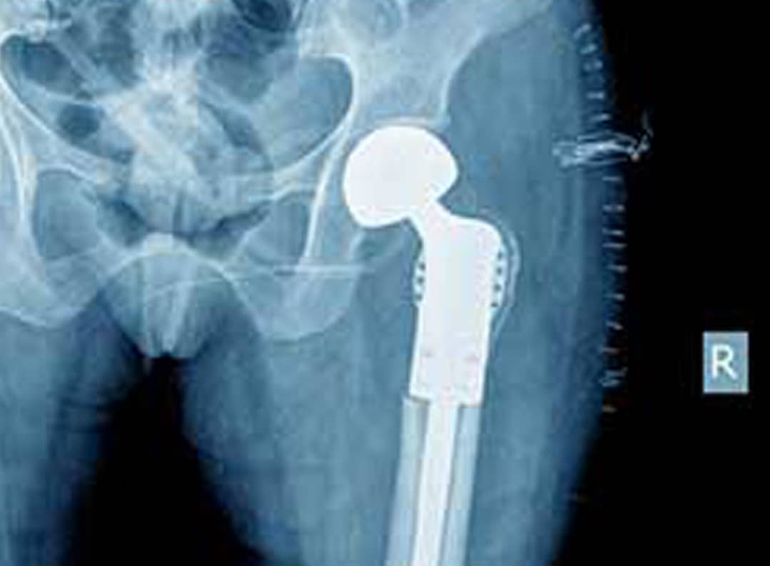 WKG Law Hip Replacement Cases