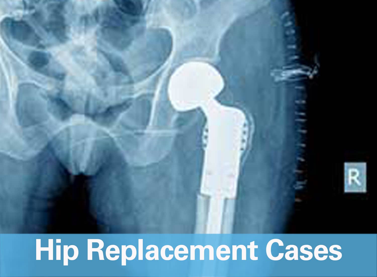 WKG Law Hip Replacement Cases