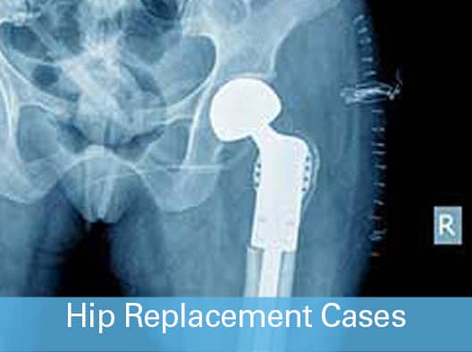 Hip Replacement Cases